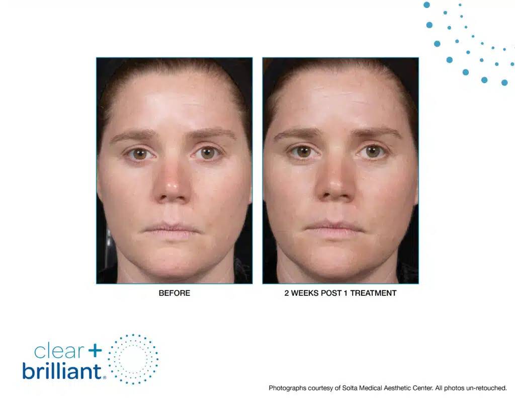 before and after clear + brilliant front view female patient New York