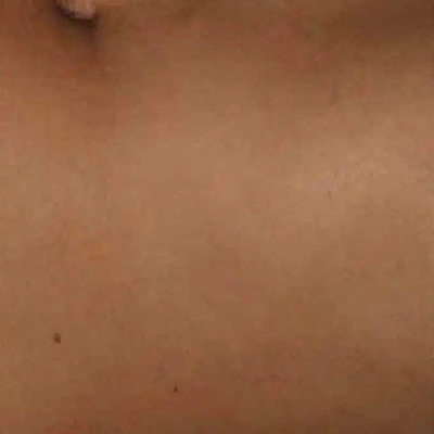 Park Ave Derm-Resurfx 1