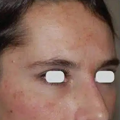 Park Ave Derm-Resurfx 6