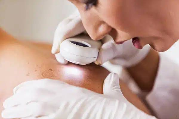 Why Annual Skin Exams are Important