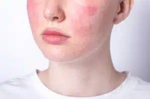 Why You Need To Work With a Dermatologist for Rosacea