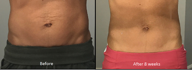 before and after skin body refining serum abdomen view female patient New York