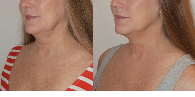 before and after cosmetic treatment left angle view female patient New York