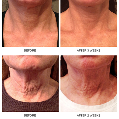 before and after cosmetic treatment neck view female patient New York