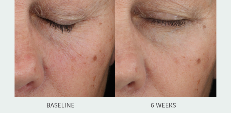 before and after Skin Retinol left eye view female patient New York