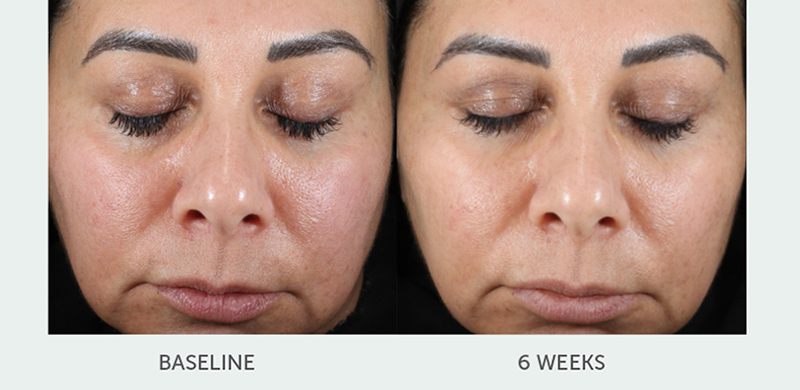 before and after Skin Retinol front view female patient New York